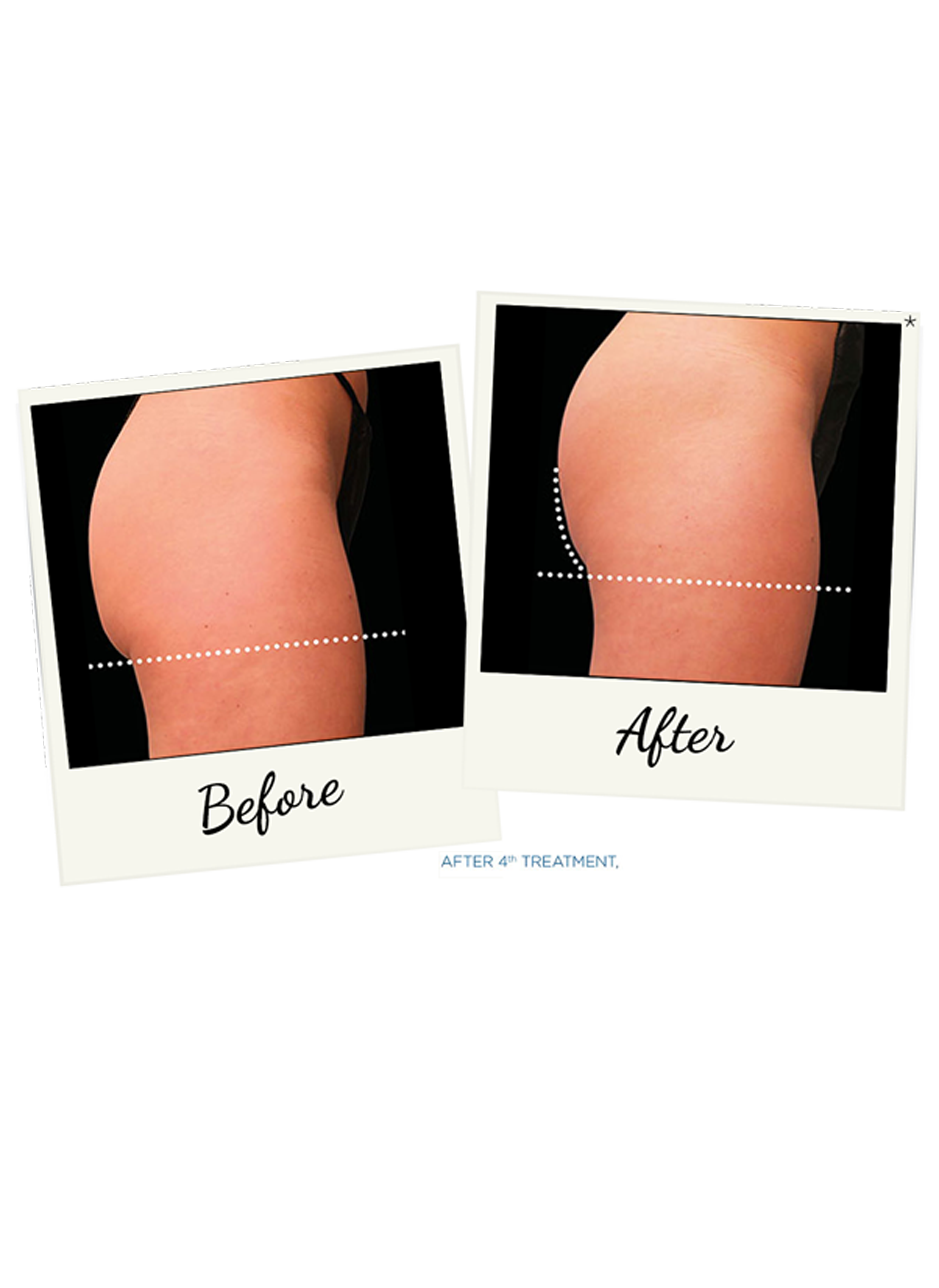 Massage for Cellulite Reduction - Colorado Natural Medicine